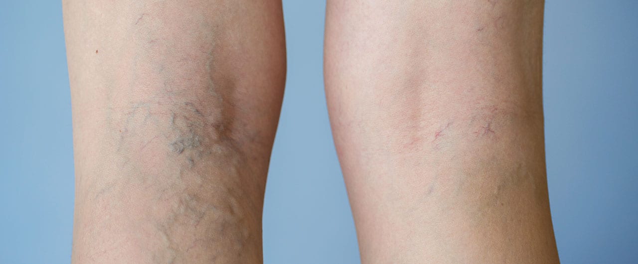 Leg Veins