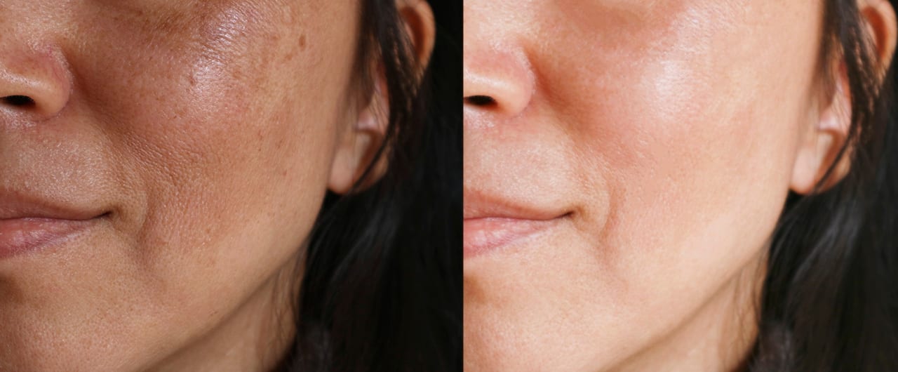 Melasma