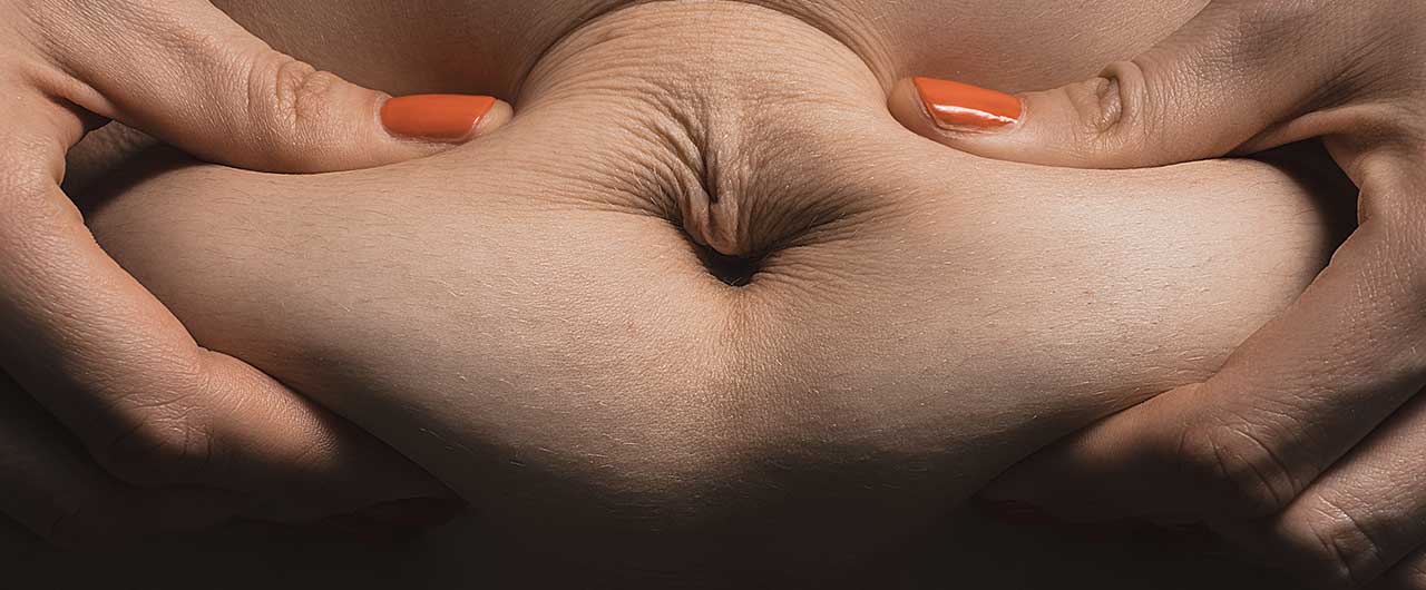 Unwanted Fat